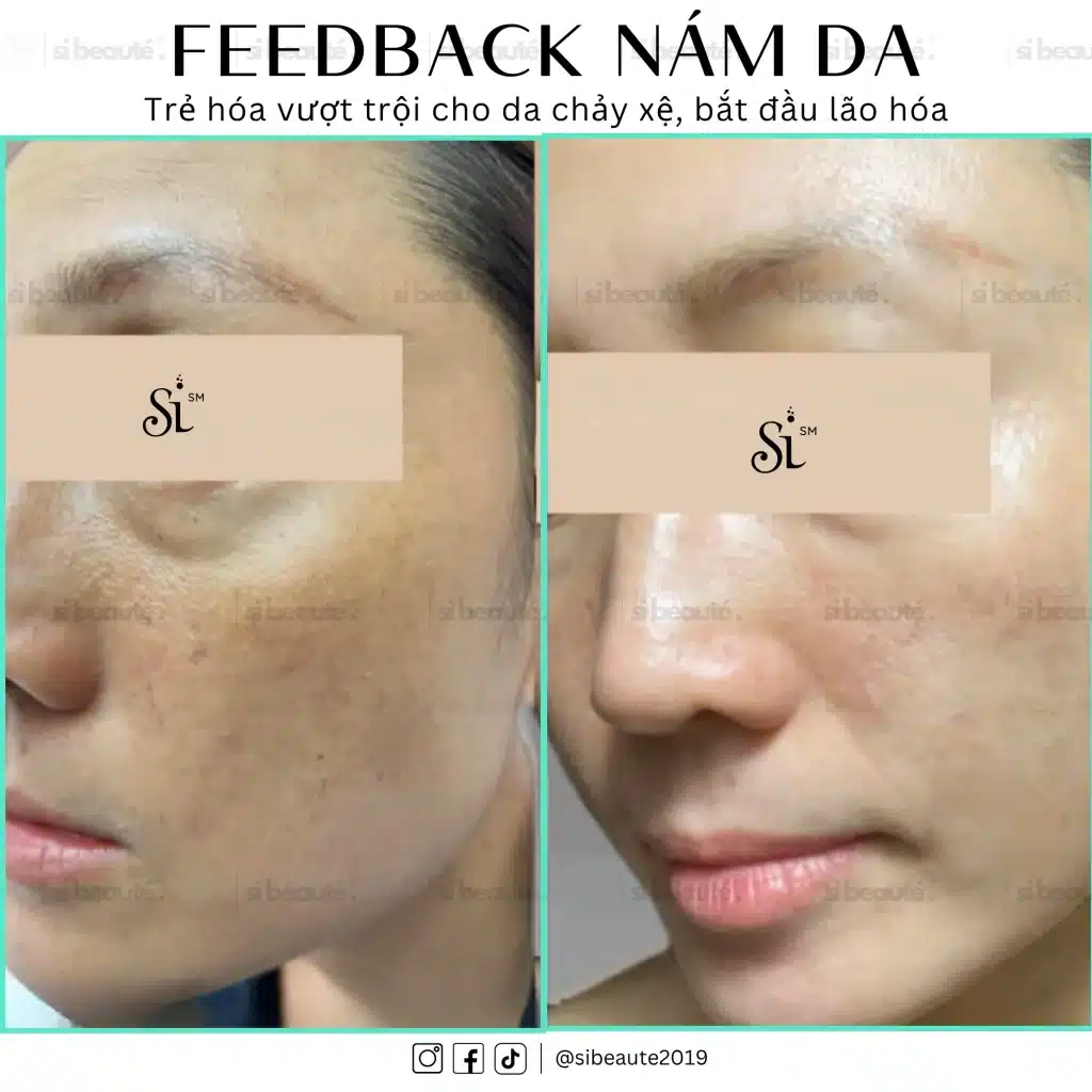 Hình ảnh trước sau của khách sau khi điều trị nám da chuẩn y khoa tại SI Beauté
