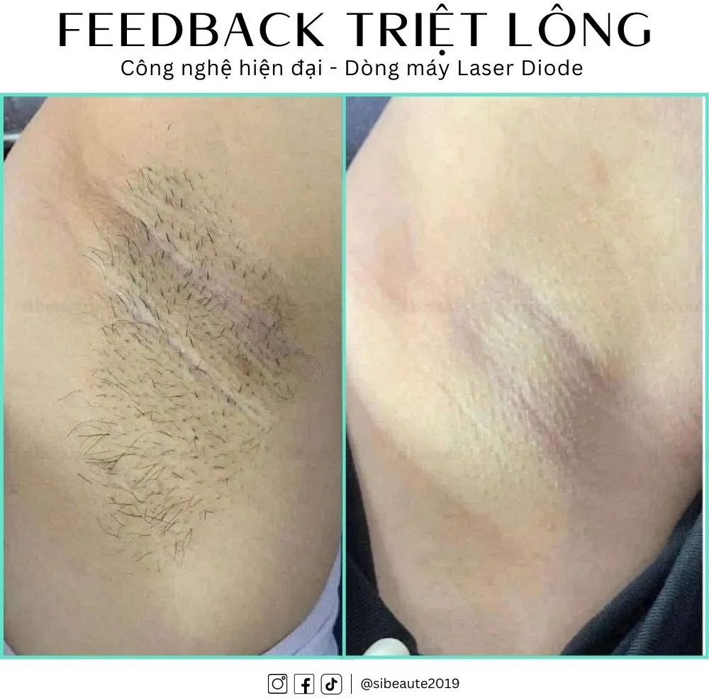 Hình ảnh khách hàng trải nghiệm triệt lông nữ tại SI Beauté
