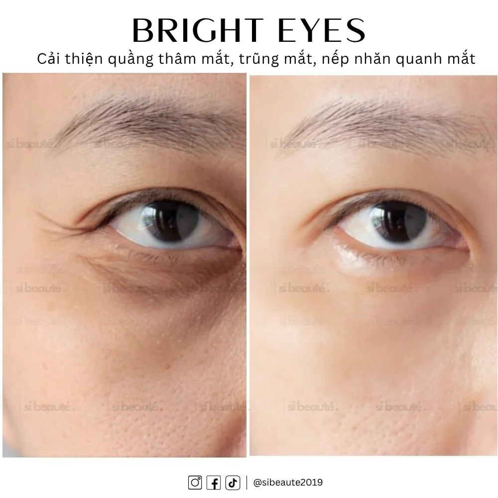 Hình ảnh khách hàng trải nghiệm bright eyes tại SI Beauté