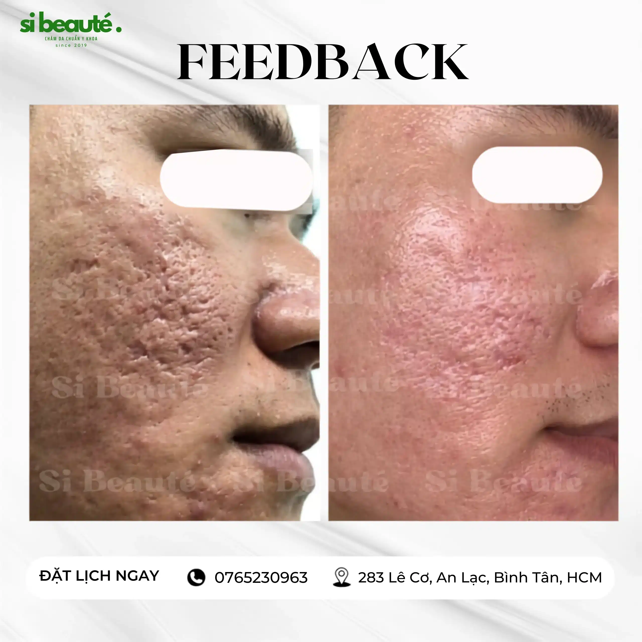 Hình ảnh trước và sau khi trị sẹo lõm tại SI Beauté