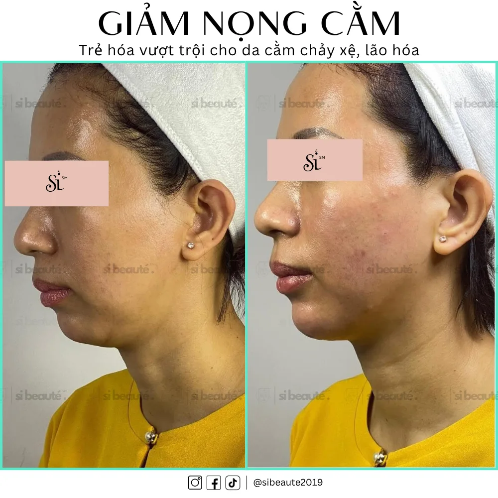 Hình ảnh khách hàng trải nghiệm giảm nọng cằm tại SI Beauté