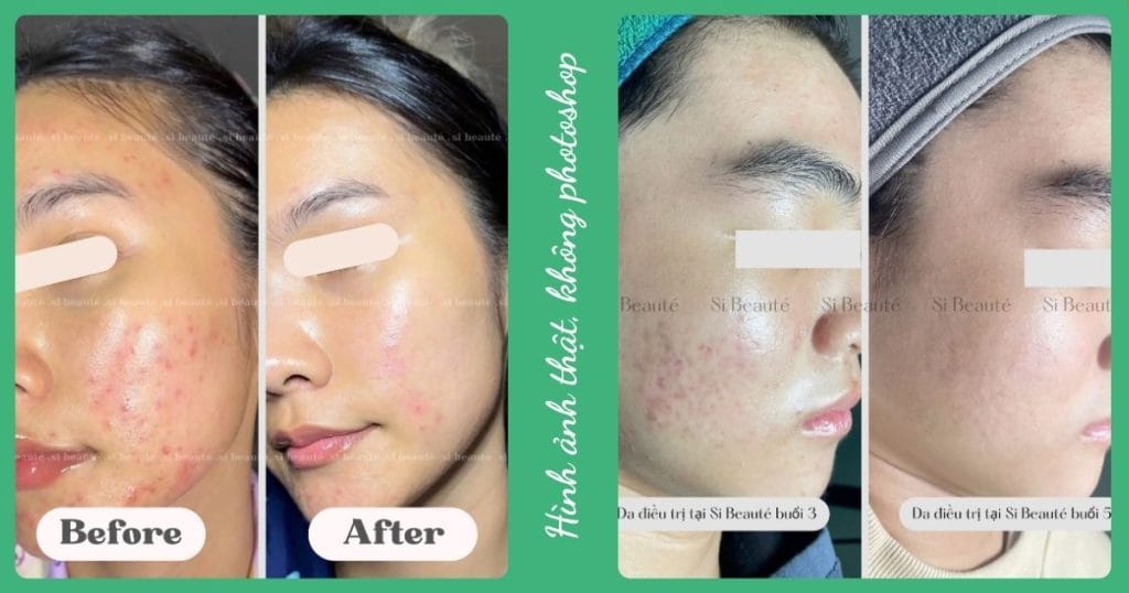 hiệu quả trị mụn chuẩn y khoa quận bình tân tại si beauté