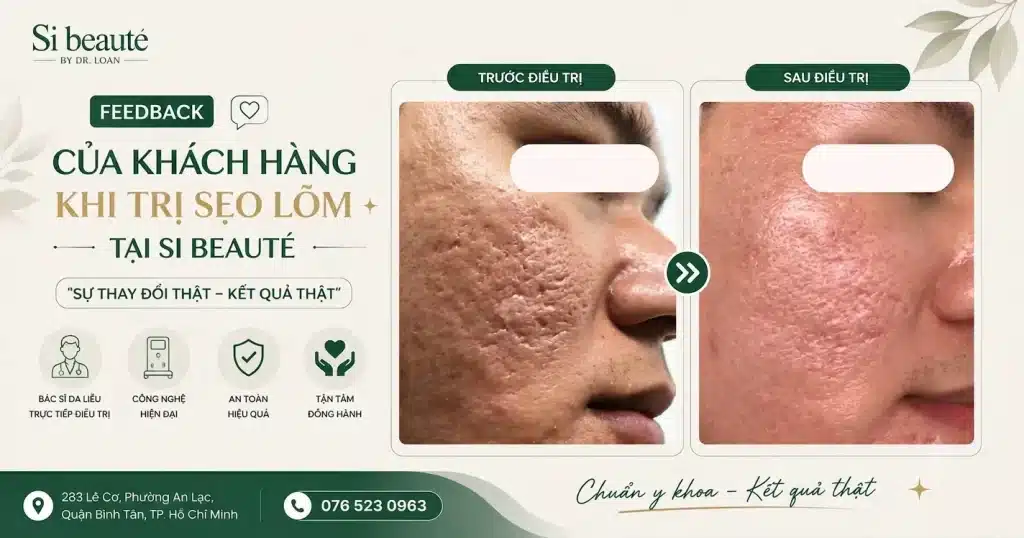 FeedBack Của Khách Hàng Khi Trị Sẹo Lõm Tại Si Beauté
