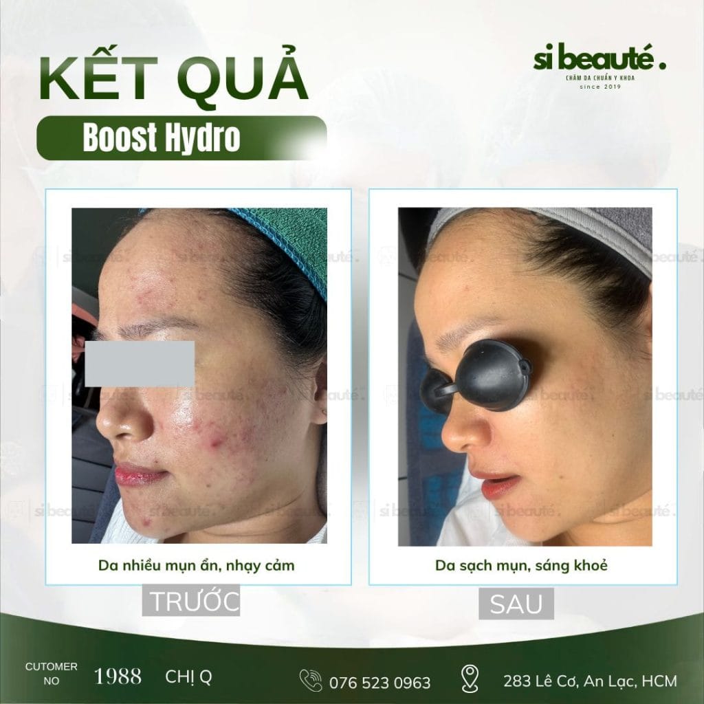 Feedback Khách Hàng Sử Dụng Liệu Trình Boost Hydro Tại SI Beauté 