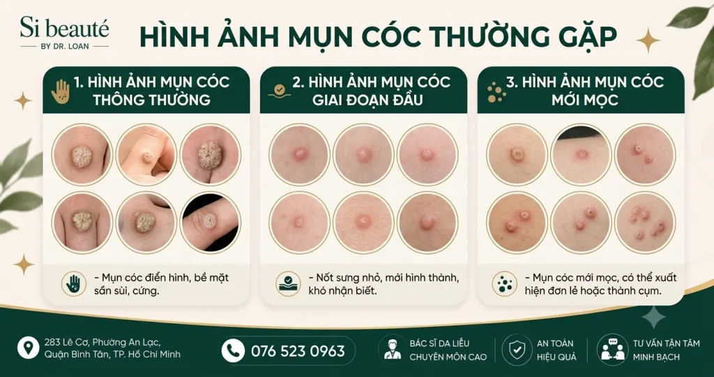 Hình Ảnh Mụn Cóc Thường Gặp