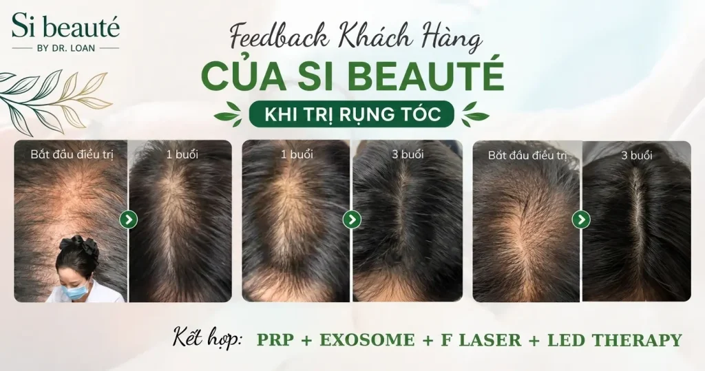 FeedBack Khách Hàng Của Si Beauté Khi Trị Rụng Tóc