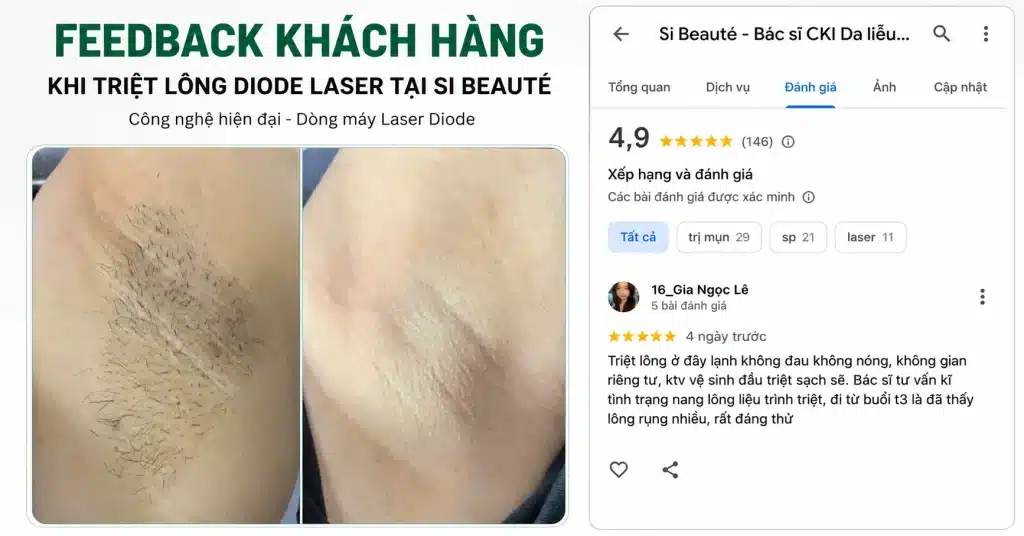 Feedback Khách Hàng Khi Triệt Lông Diode Laser Tại SI Beauté