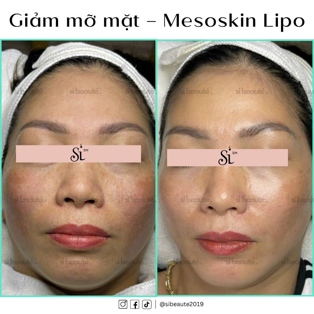 Hình ảnh trước sau của khách hàng khi làm dịch vụ giảm mỡ mặt – Mesoskin Lipo