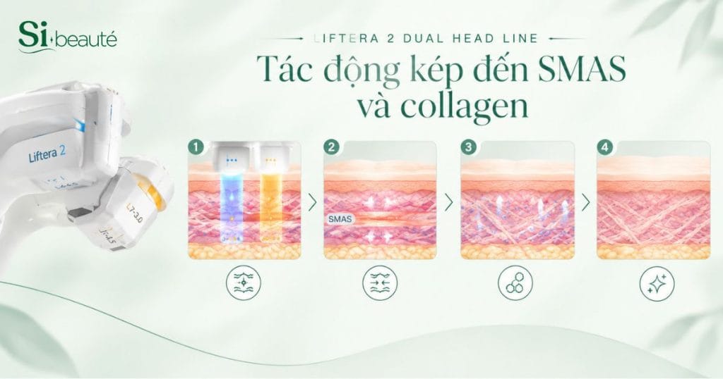 Cơ chế hoạt động của công nghệ Hifu Line - Tạo ảnh bởi AI