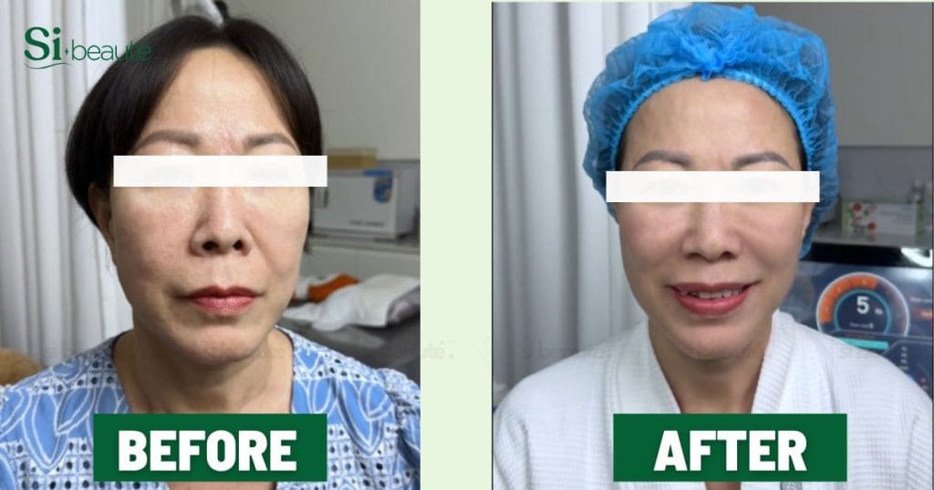 Feedback khách hàng sau khi sử dụng dịch vụ Hifu Line tại SI Beauté
