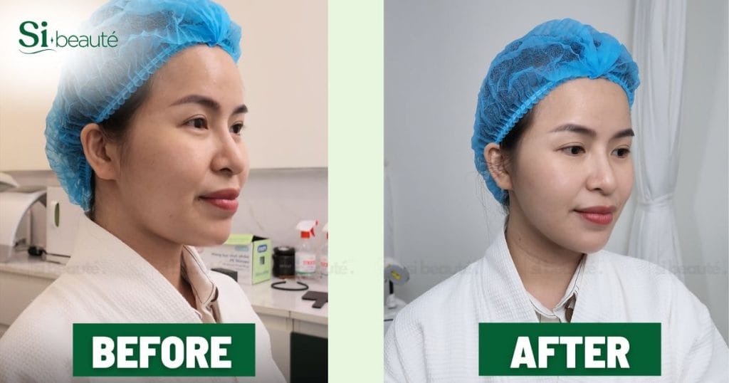 Before After khách hàng khi sử dụng dịch vụ săn chắc da hifu pen tại Si Beauté