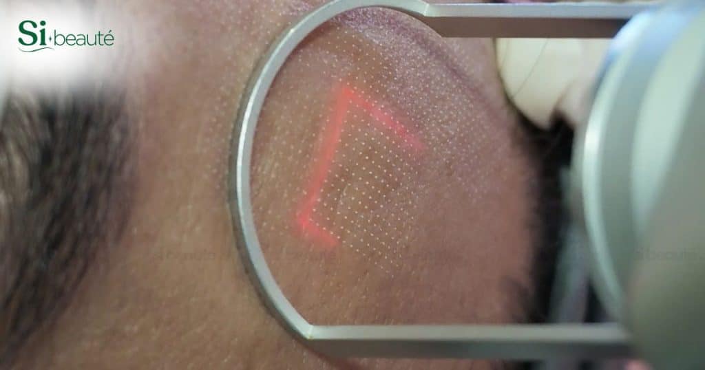 Cận ảnh làm F Laser trị sẹo lõm cho khách tại Si Beauté
