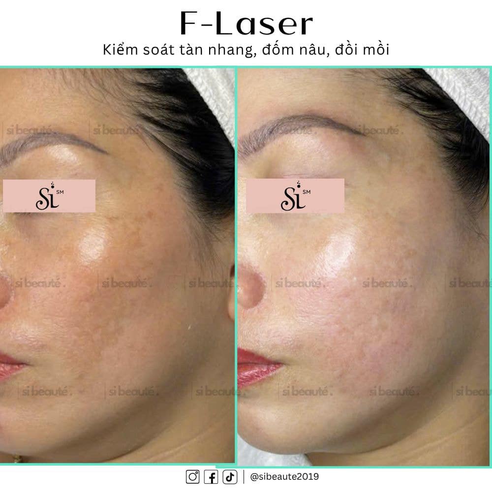 Feedback khách hàng trị tàn nhang, đốm nâu, đồi mồi bằng F-Laser tại Si Beauté