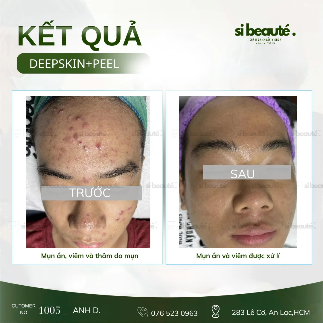 Trước và sau điều trị mụn Deepskin + Peel - KH 1005 Anh D.: Mụn ẩn, viêm và thâm do mụn -> Mụn ẩn và viêm được xử lý