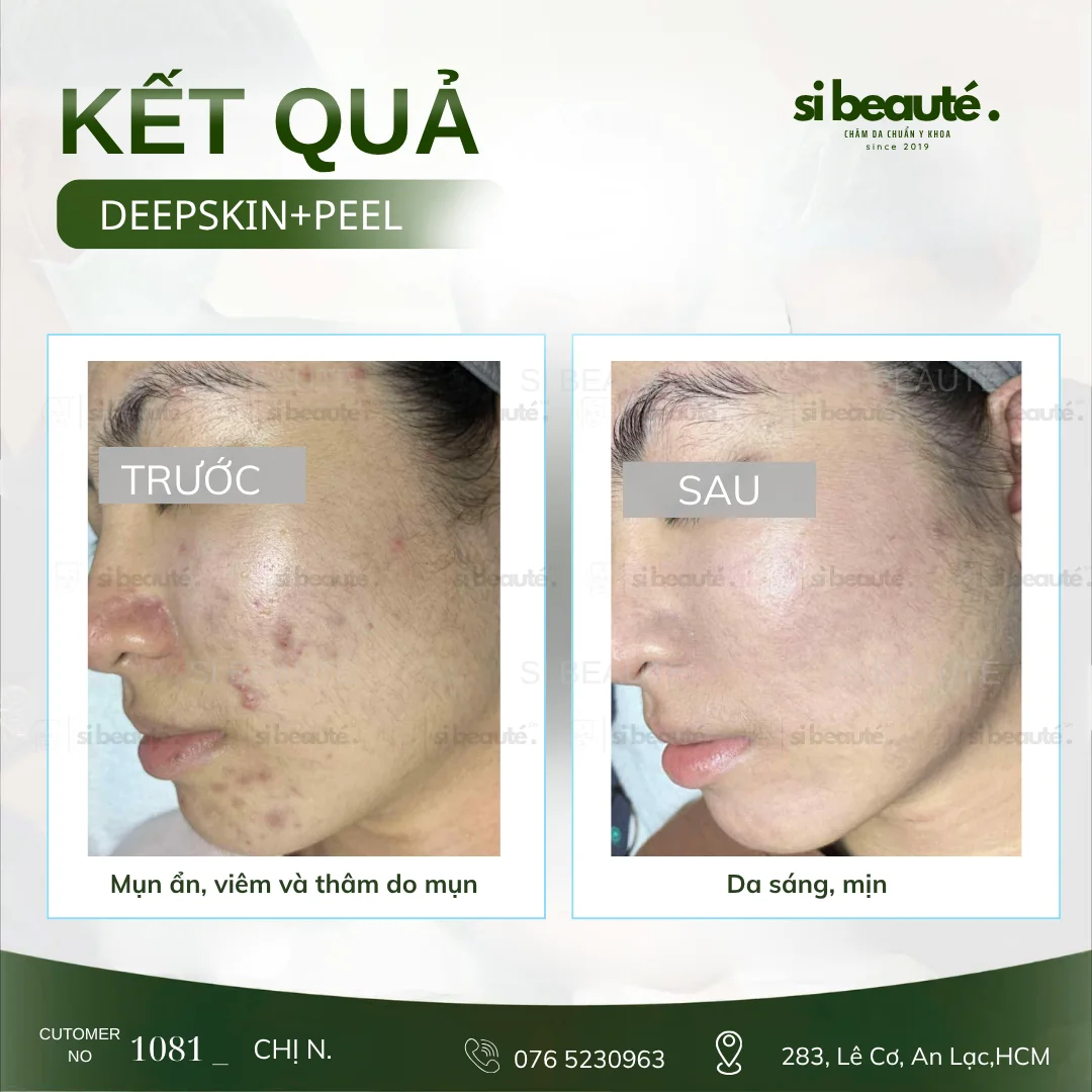 Trước và sau điều trị mụn Deepskin + Peel - KH 1081 Chị N.: Mụn ẩn, viêm và thâm do mụn -> Da sáng, mịn