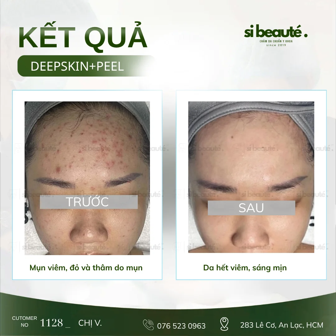 Trước và sau điều trị mụn Deepskin + Peel - KH 1128 Chị V.: Mụn viêm, đỏ và thâm do mụn -> Da hết viêm, sáng mịn