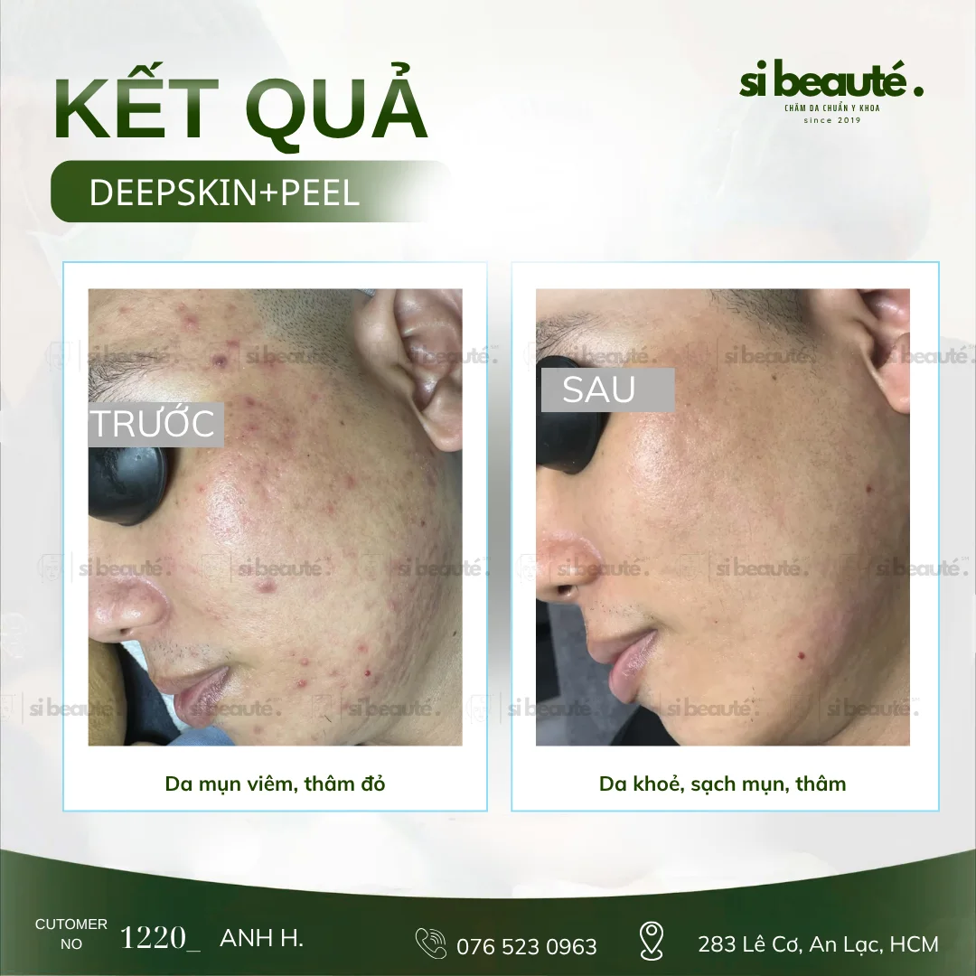Trước và sau điều trị mụn Deepskin + Peel - KH 1220 Anh H.: Da mụn viêm, thâm đỏ -> Da khỏe, sạch mụn, thâm