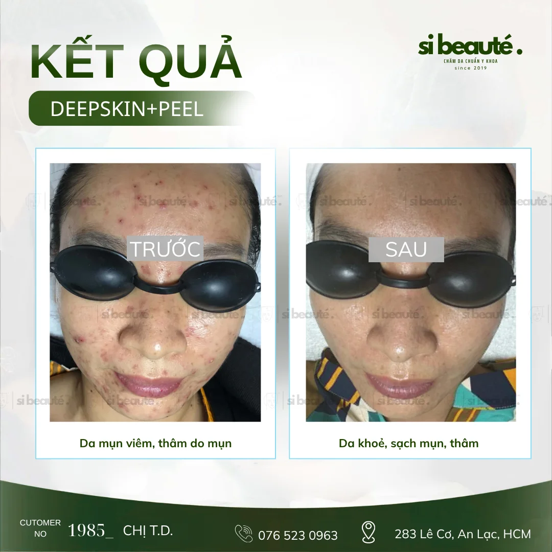 Trước và sau điều trị mụn Deepskin + Peel - KH 1985 Chị T.D.: Da mụn viêm, thâm do mụn -> Da khỏe, sạch mụn, thâm