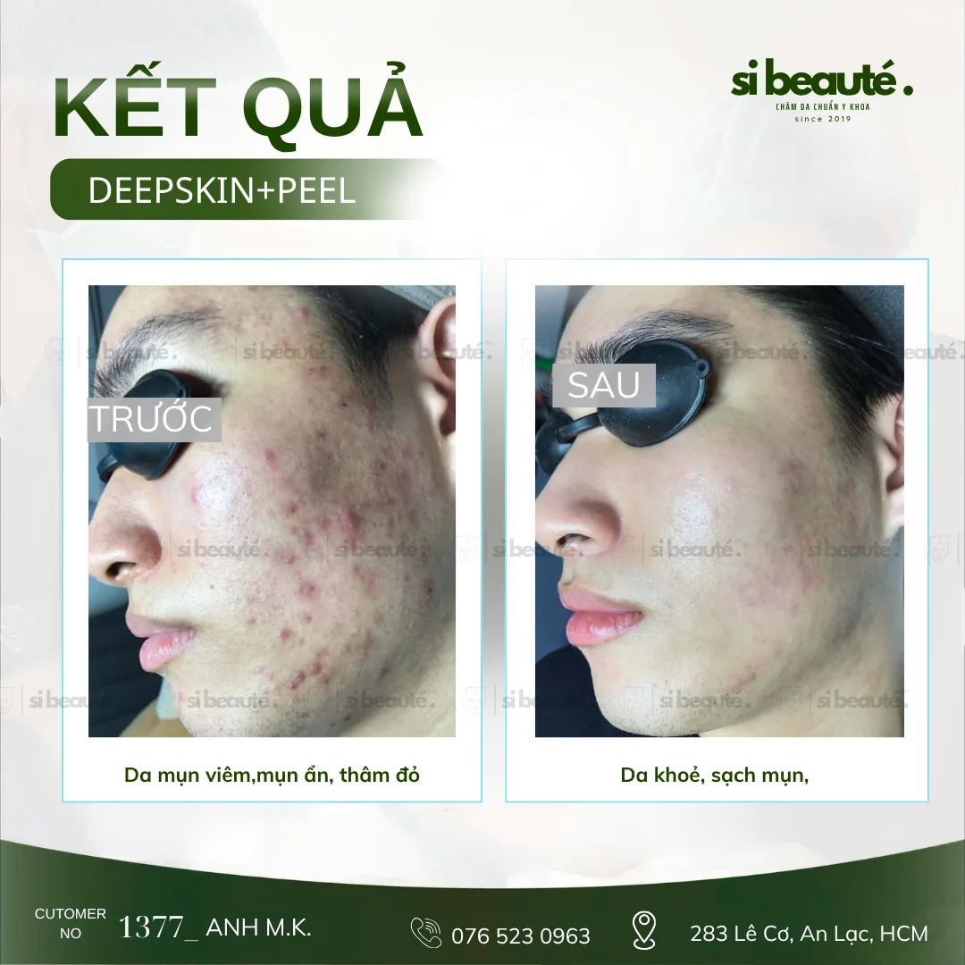 Trước và sau điều trị mụn Deepskin + Peel - KH 1377 Anh M.K.: Da mụn viêm, mụn ẩn, thâm đỏ -> Da khỏe, sạch mụn