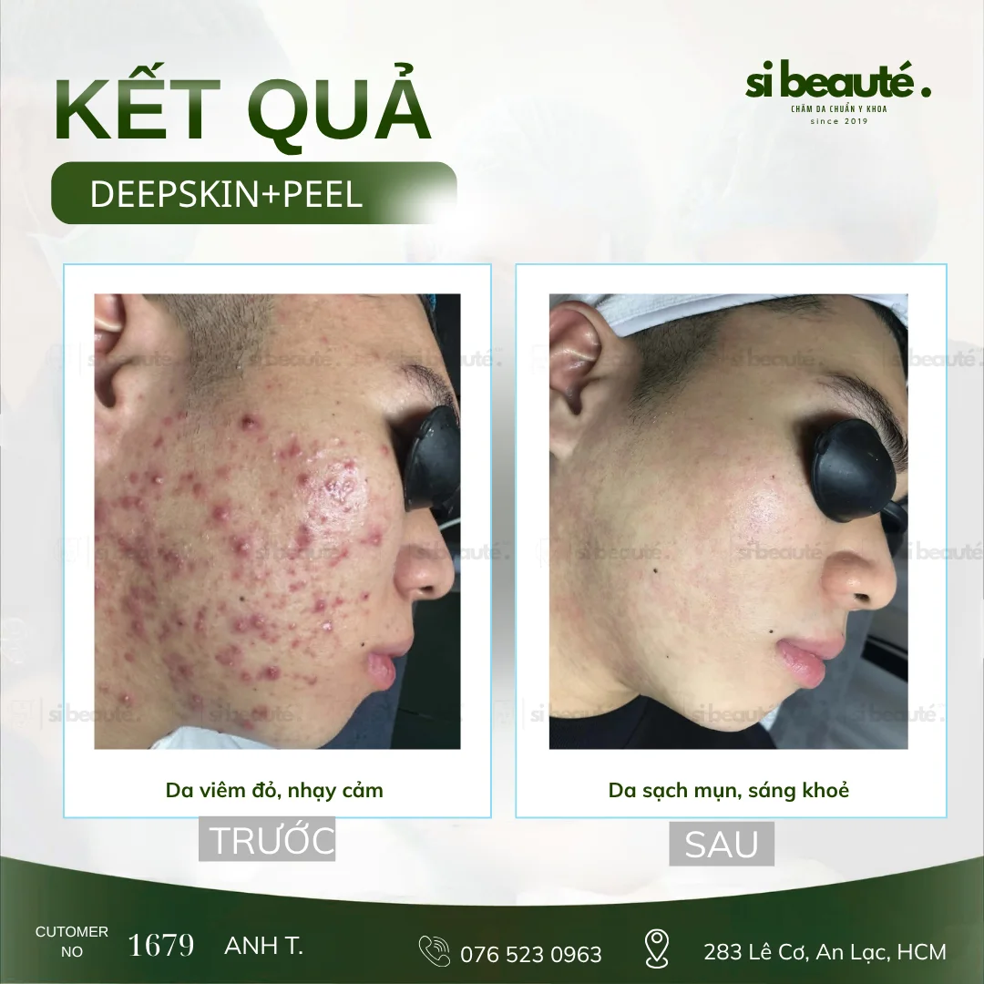 Trước và sau điều trị mụn Deepskin + Peel - KH 1679 Anh T.: Da viêm đỏ, nhạy cảm -> Da sạch mụn, sáng khỏe