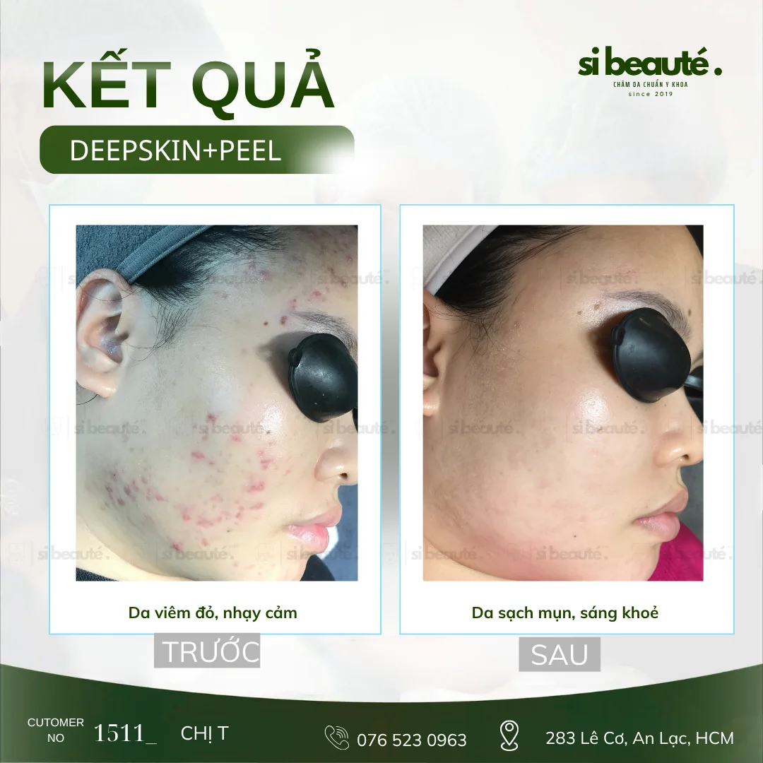 Trước và sau điều trị mụn Deepskin + Peel - KH 1511 Chị T.: Da viêm đỏ, nhạy cảm -> Da sạch mụn, sáng khỏe