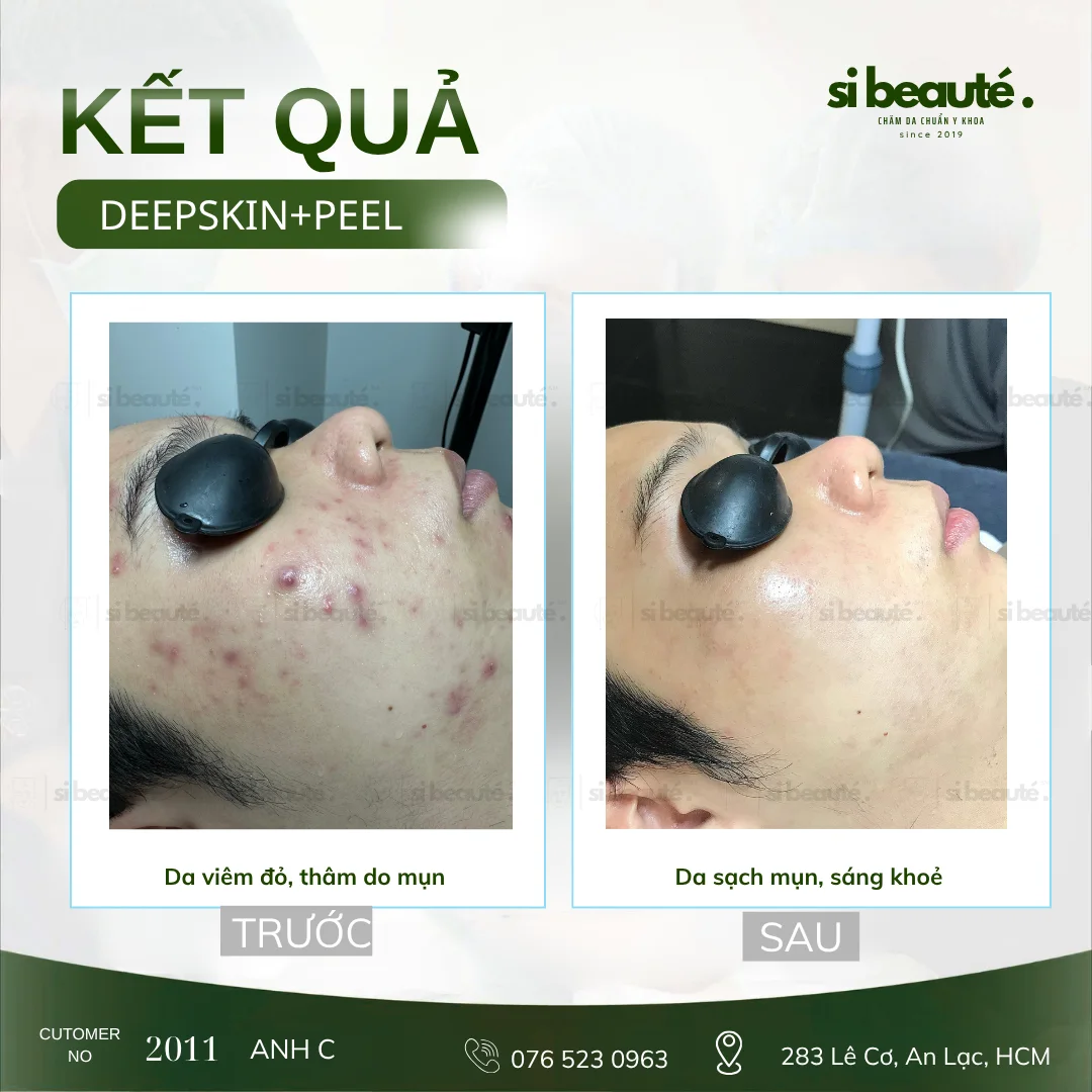 Trước và sau điều trị mụn Deepskin + Peel - KH 2011 Anh C.: Da viêm đỏ, thâm do mụn -> Da sạch mụn, sáng khỏe