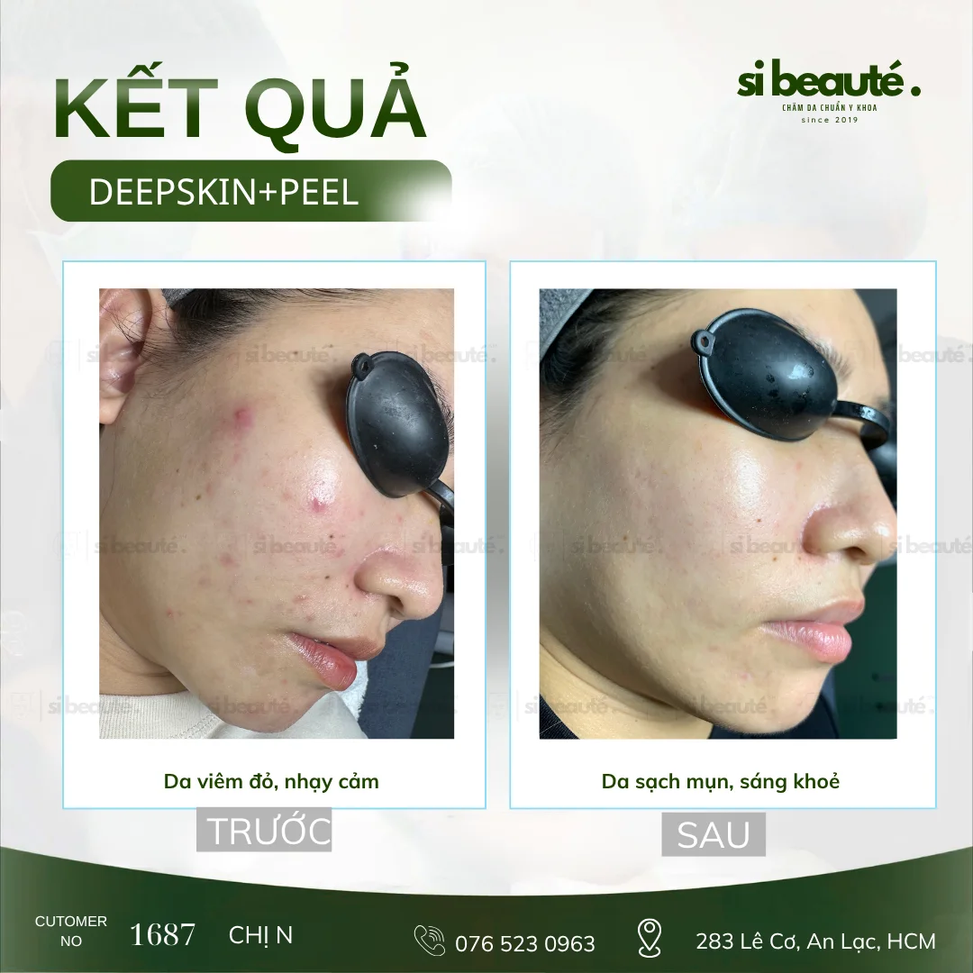 Trước và sau điều trị mụn Deepskin + Peel - KH 1687 Chị N.: Da viêm đỏ, nhạy cảm -> Da sạch mụn, sáng khỏe