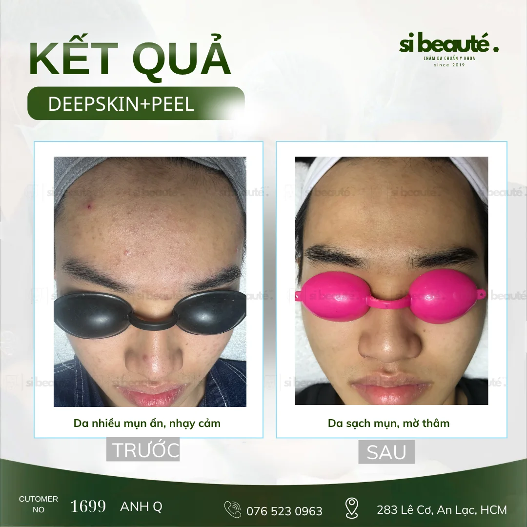 Trước và sau điều trị mụn Deepskin + Peel - KH 1699 Anh Q.: Da nhiều mụn ẩn, nhạy cảm -> Da sạch mụn, mờ thâm
