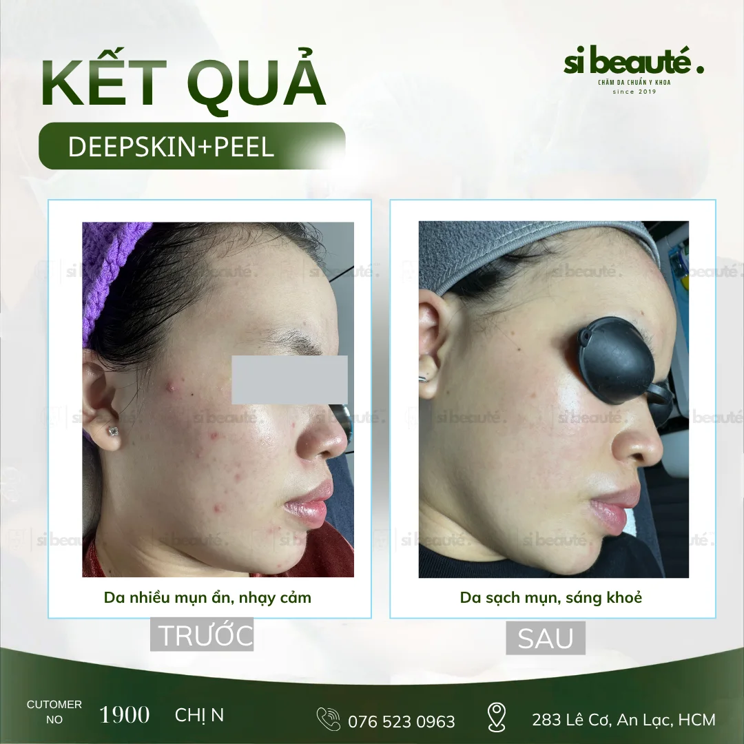 Trước và sau điều trị mụn Deepskin + Peel - KH 1900 Chị N.: Da nhiều mụn ẩn, nhạy cảm -> Da sạch mụn, sáng khỏe