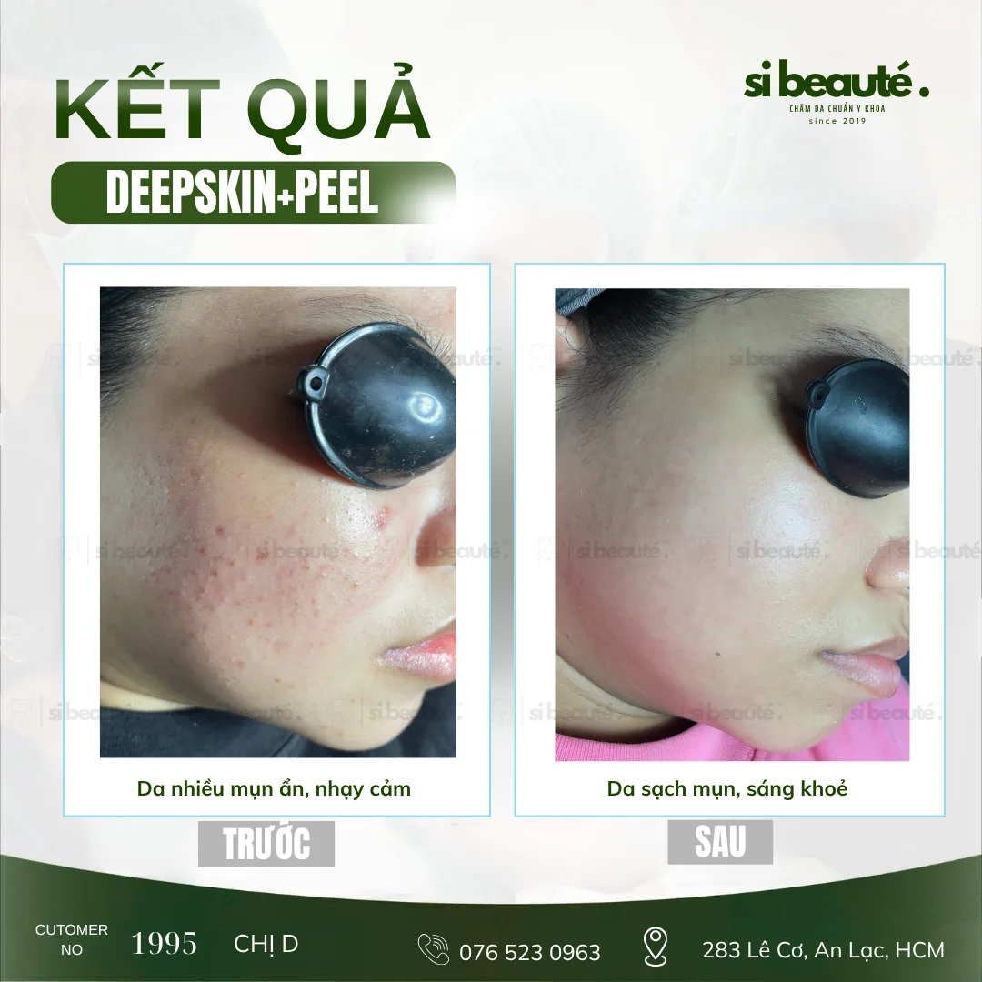 Trước và sau điều trị mụn Deepskin + Peel - KH 1995 Chị D.: Da nhiều mụn ẩn, nhạy cảm -> Da sạch mụn, sáng khỏe