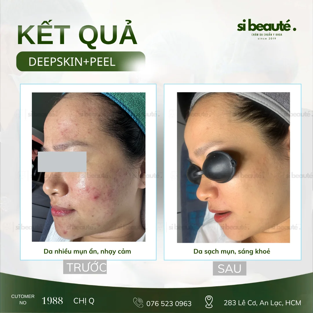 Trước và sau điều trị mụn Deepskin + Peel - KH 1988 Chị Q.: Da nhiều mụn ẩn, nhạy cảm -> Da sạch mụn, sáng khỏe