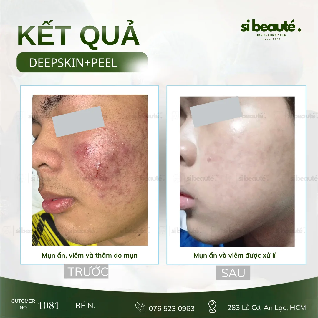 Trước và sau điều trị mụn Deepskin + Peel - KH 1081 Bé N.: Mụn ẩn, viêm và thâm do mụn -> Mụn ẩn và viêm được xử lý
