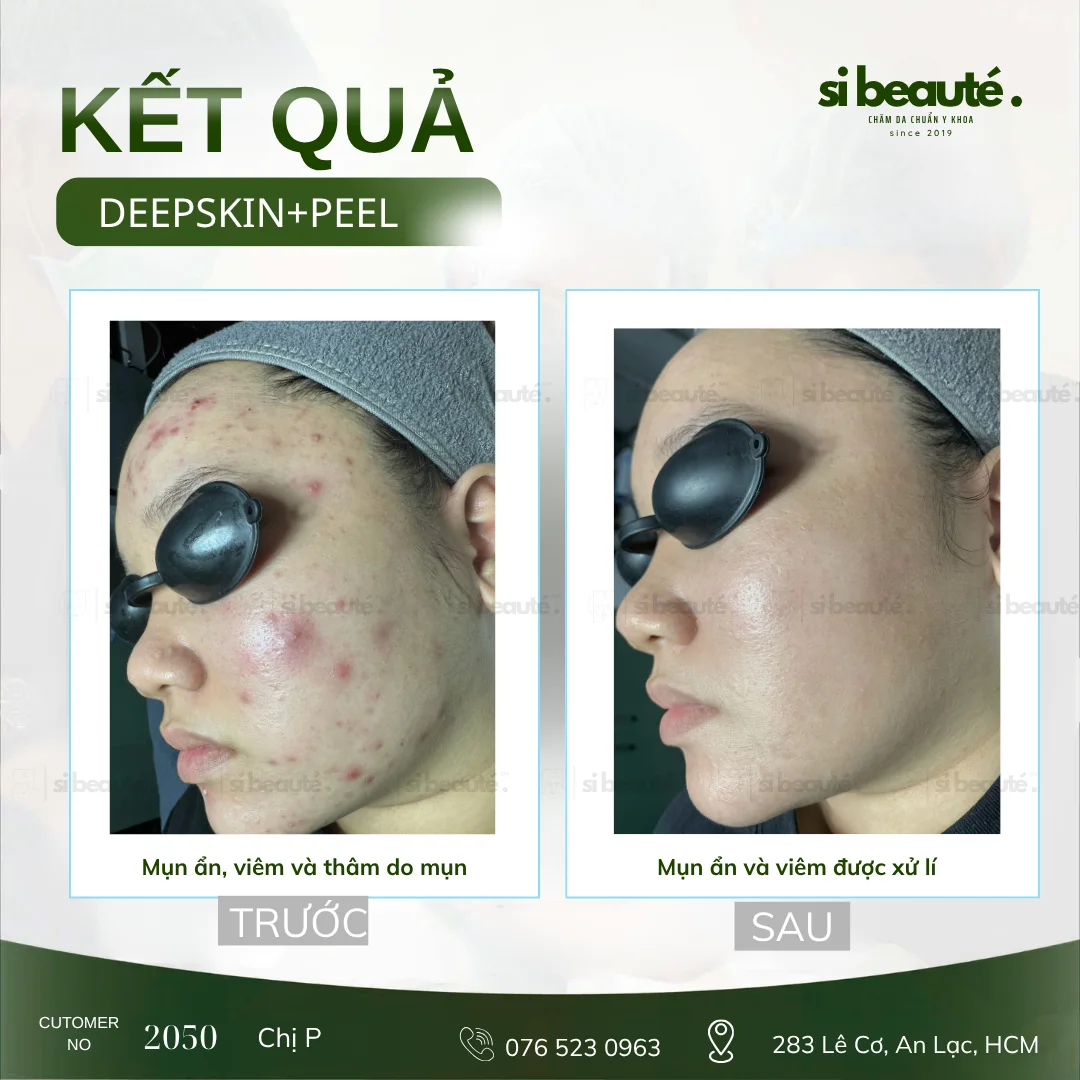 Trước và sau điều trị mụn Deepskin + Peel - KH 2050 Chị P.: Mụn ẩn, viêm và thâm do mụn -> Mụn ẩn và viêm được xử lý