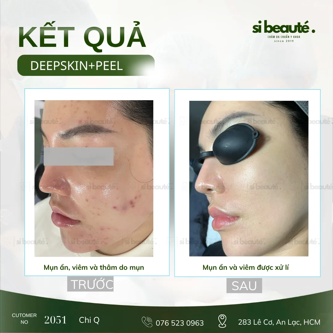 Trước và sau điều trị mụn Deepskin + Peel - KH 2051 Chị Q.: Mụn ẩn, viêm và thâm do mụn -> Mụn ẩn và viêm được xử lý