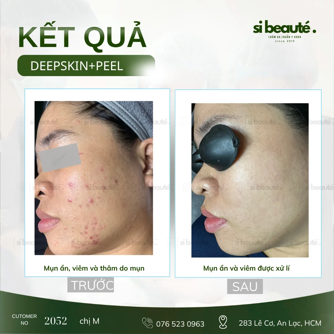 Trước và sau điều trị mụn Deepskin + Peel - KH 2052 Chị M.: Mụn ẩn, viêm và thâm do mụn -> Mụn ẩn và viêm được xử lý