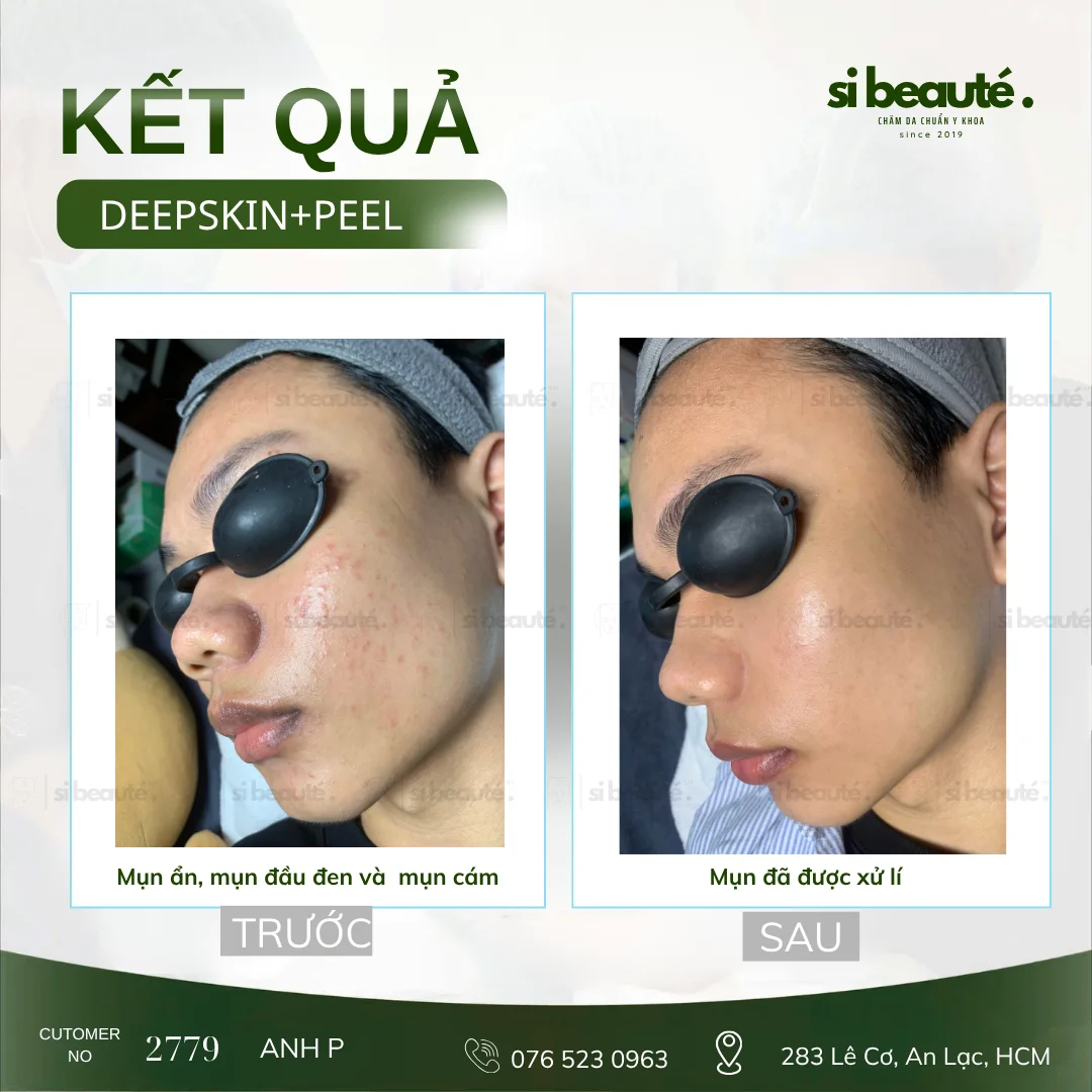 Trước và sau điều trị mụn Deepskin + Peel - KH 2779 Anh P.: Mụn ẩn, mụn đầu đen và mụn cám -> Mụn đã được xử lý