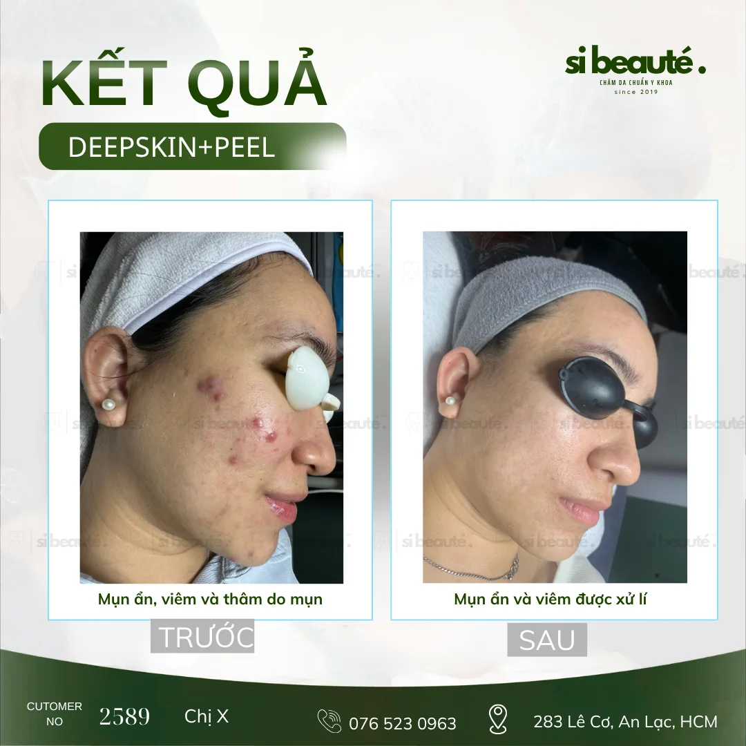 Trước và sau điều trị mụn Deepskin + Peel - KH 2589 Chị X.: Mụn ẩn, viêm và thâm do mụn (Má phải) -> Mụn ẩn và viêm được xử lý