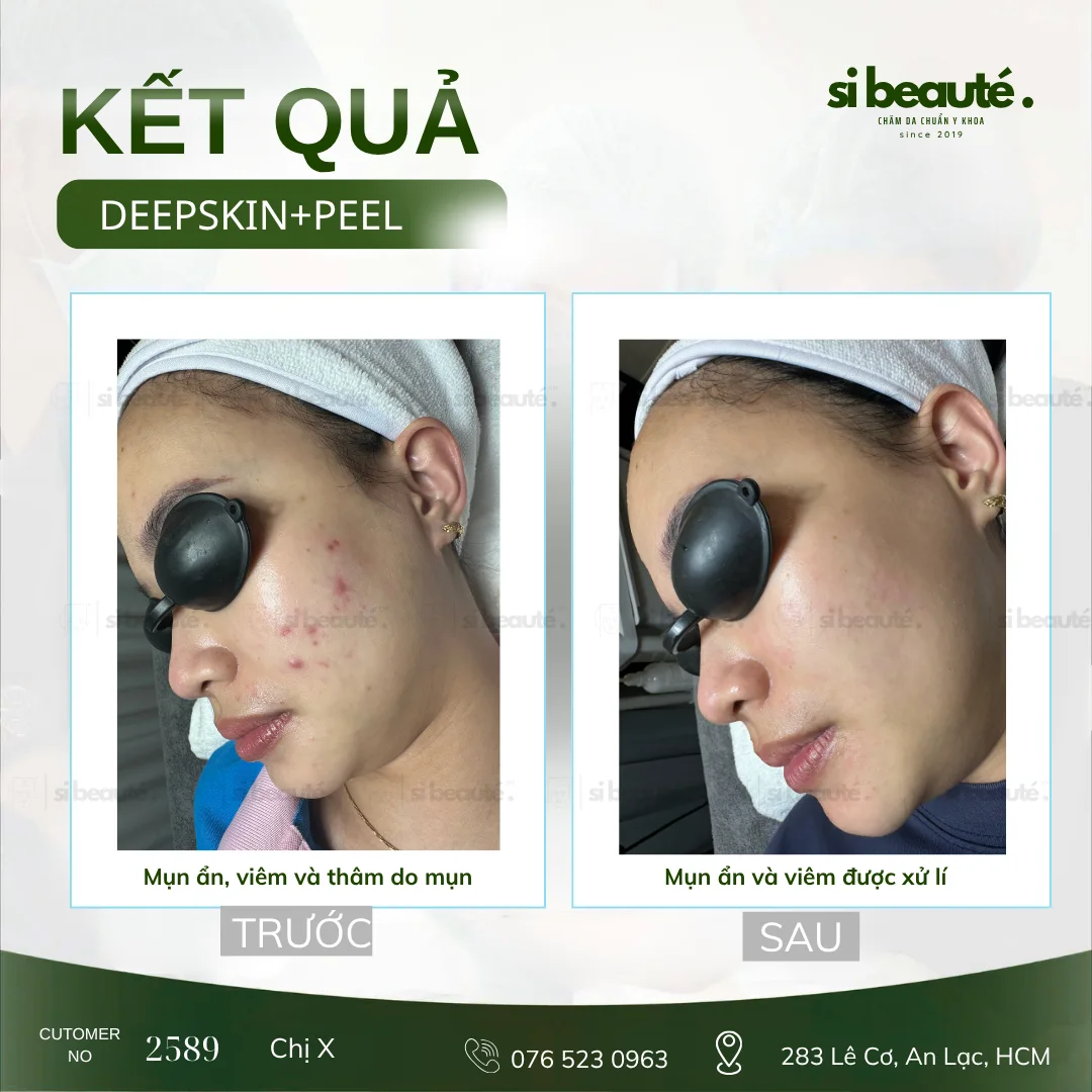 Trước và sau điều trị mụn Deepskin + Peel - KH 2589 Chị X.: Mụn ẩn, viêm và thâm do mụn (Má trái) -> Mụn ẩn và viêm được xử lý